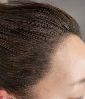 헤어라인 후